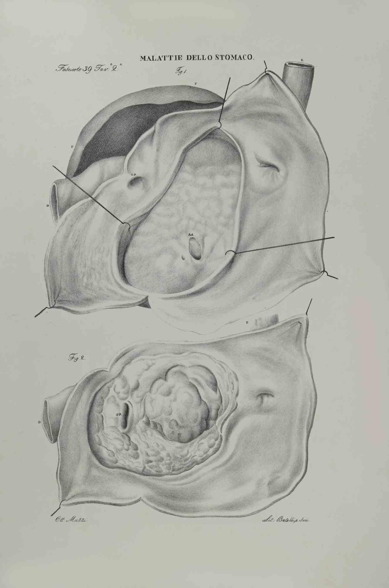 Stomach Diseases is a lithograph by Ottavio Muzzi for the edition of Antoine Chazal, Human Anatomy, Printers Batelli and Ridolfi, 1843.

The work belongs to the Atlante generale della anatomia patologica del corpo umano by Jean CRUVEILHIER,