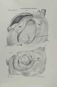 Antique Stomach Diseases - Lithograph By Ottavio Muzzi - 1843