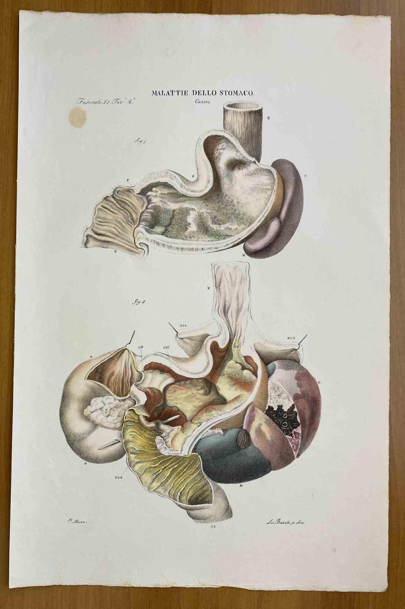 Stomach Diseases ist eine handkolorierte Lithographie von Ottavio Muzzi für die Ausgabe von Antoine Chazal, Human Anatomy, Printers Batelli and Ridolfi, 1843.

Das Werk gehört zum Atlante generale della anatomia patologica del corpo umano von Jean