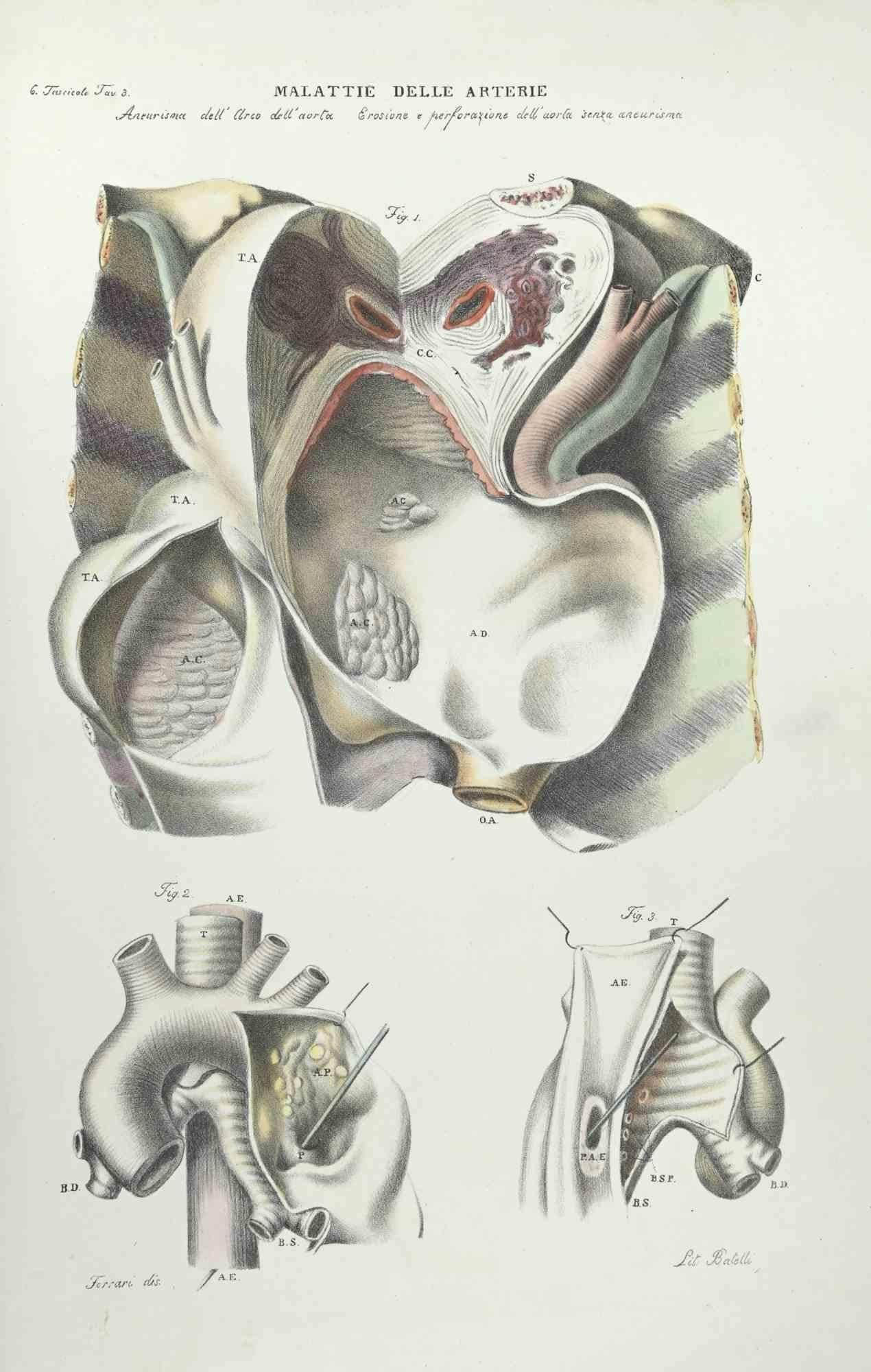 Stomach Diseases is a lithograph hand colored by Ottavio Muzzi for the edition of Antoine Chazal, Human Anatomy, Printers Batelli and Ridolfi, 1843.

The work belongs to the Atlante generale della anatomia patologica del corpo umano by Jean