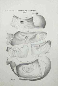 Antique Stomach Diseases - Lithograph By Ottavio Muzzi - 1843