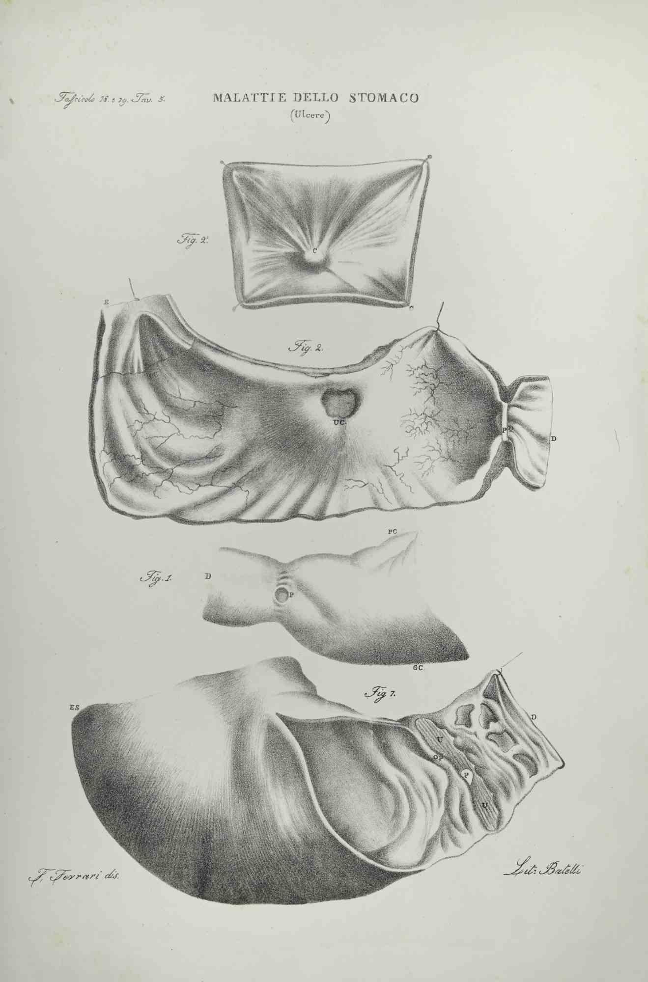 Lithographie « Stomach Diseases » d'Ottavio Muzzi, 1843
