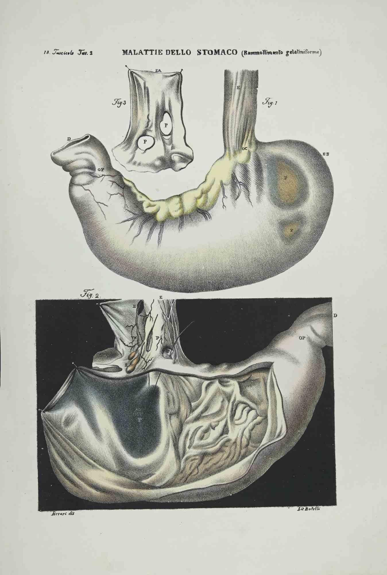 Stomach Diseases is a lithograph hand colored by Ottavio Muzzi for the edition of Antoine Chazal, Human Anatomy, Printers Batelli and Ridolfi, 1843.

The work belongs to the Atlante generale della anatomia patologica del corpo umano by Jean