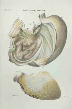 Antique Stomach Diseases - Lithograph By Ottavio Muzzi - 1843