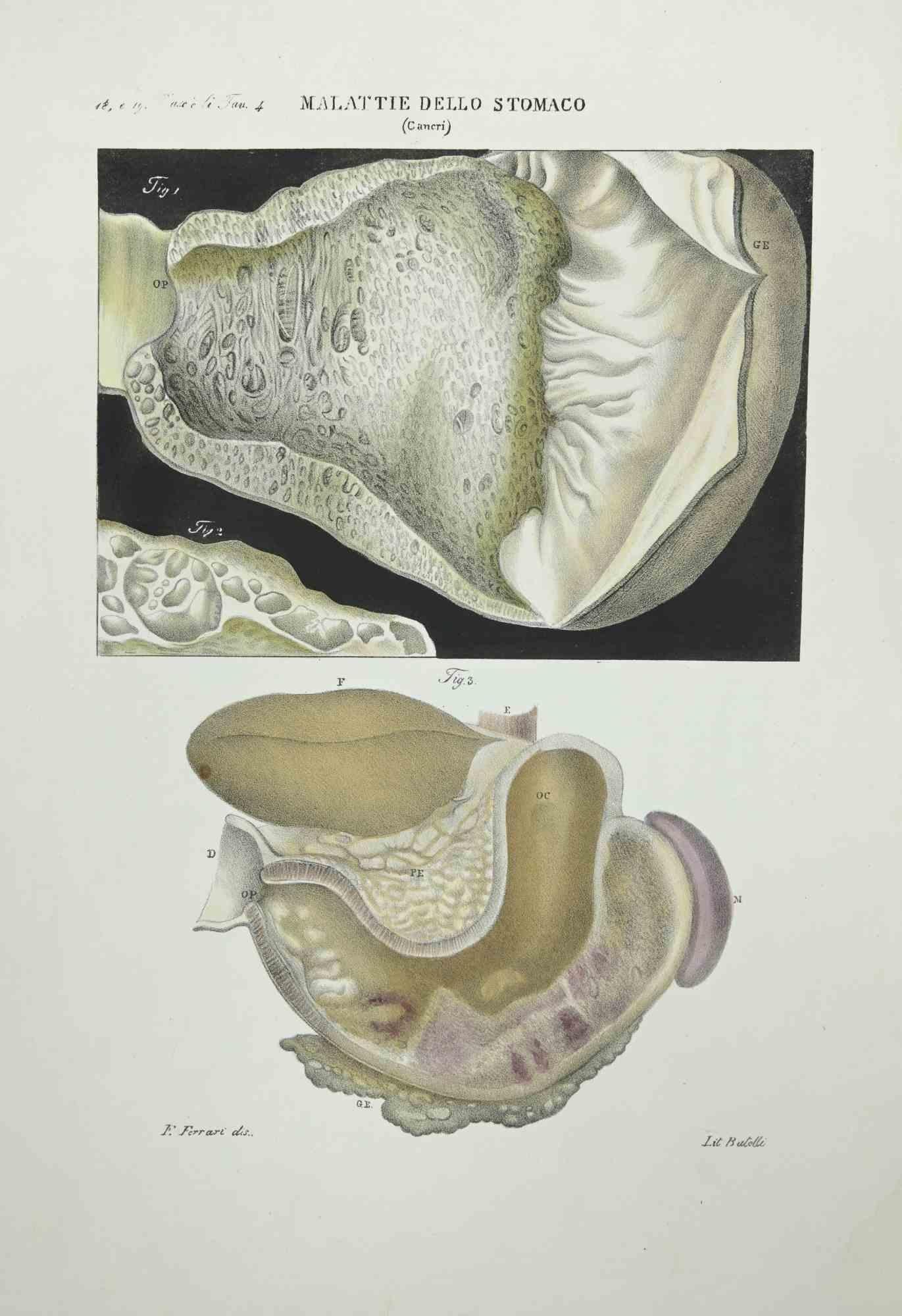 Stomach Diseases ist eine handkolorierte Lithographie von Ottavio Muzzi für die Ausgabe von Antoine Chazal, Human Anatomy, Printers Batelli and Ridolfi, 1843.

Das Werk gehört zum Atlante generale della anatomia patologica del corpo umano von Jean