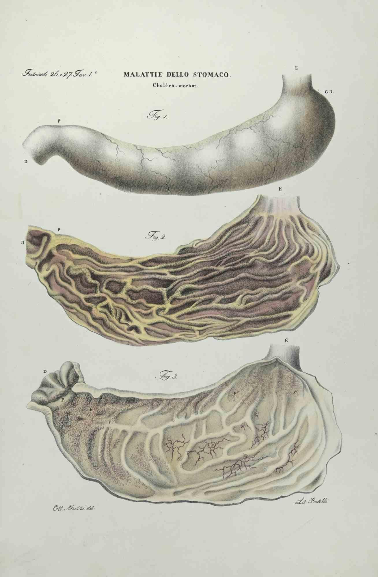 Stomach Diseases is a lithograph hand colored by Ottavio Muzzi for the edition of Antoine Chazal,Human Anatomy, Printers Batelli and Ridolfi, realized in 1843.
Signed on plate on the lower left margin. 

The artwork belongs to the "Atlante Generale