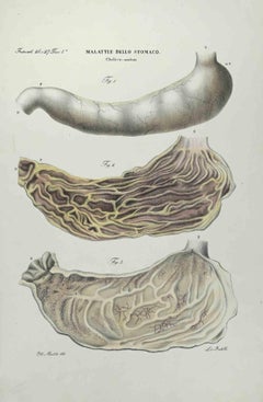 Stomach Diseases - Lithograph By Ottavio Muzzi - 1843