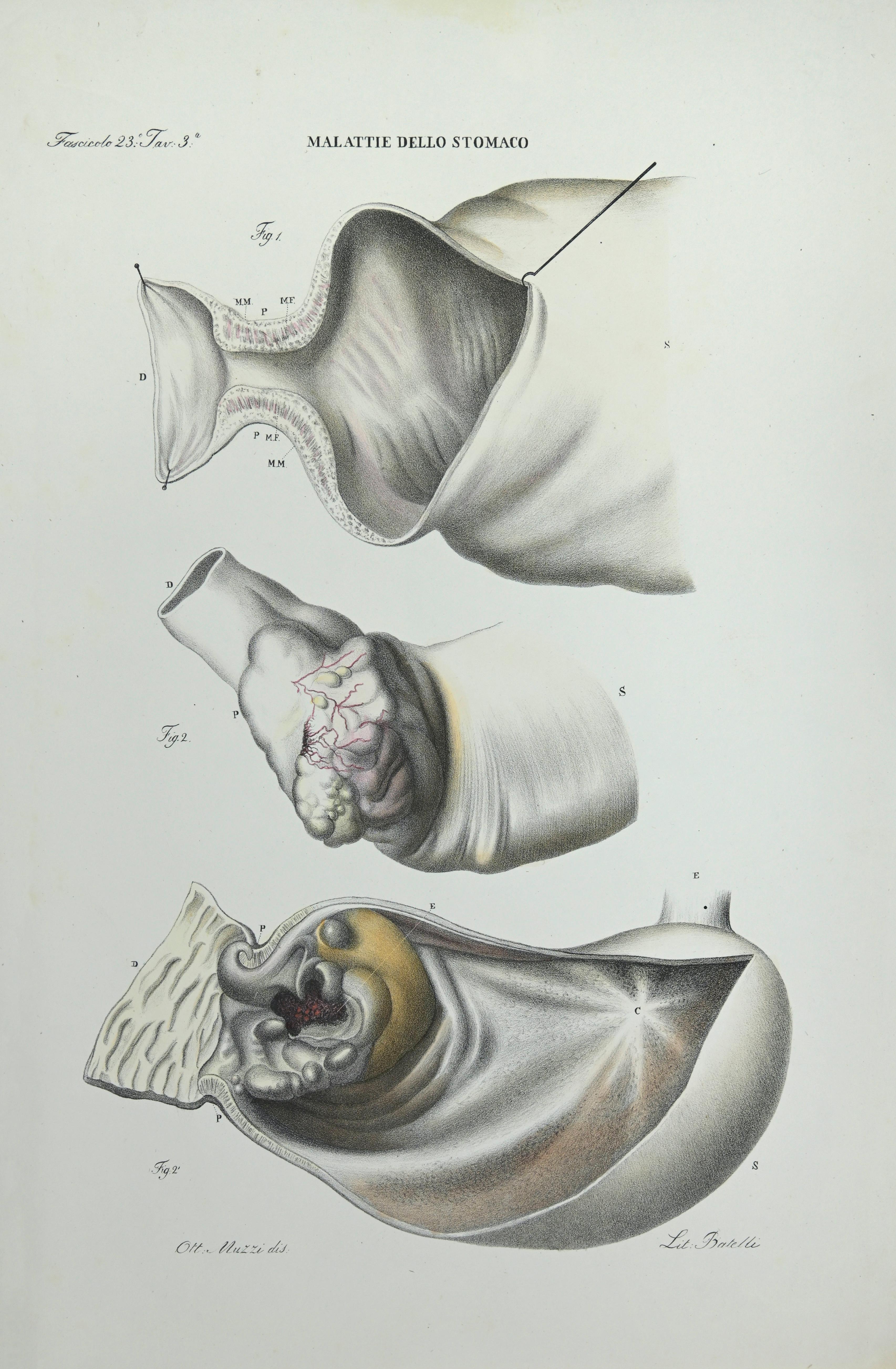 Erkrankungen des Magens   ist eine handkolorierte Lithographie von Ottavio Muzzi für die Ausgabe von Antoine Chazal, Human Anatomy, Druckerei Batelli und Ridolfi, aus dem Jahr 1843.
Signiert auf der Platte am unteren linken Rand. 

Das Kunstwerk