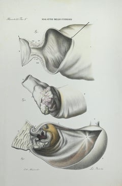 Stomachkrankheiten – Lithographie von Ottavio Muzzi – 1843