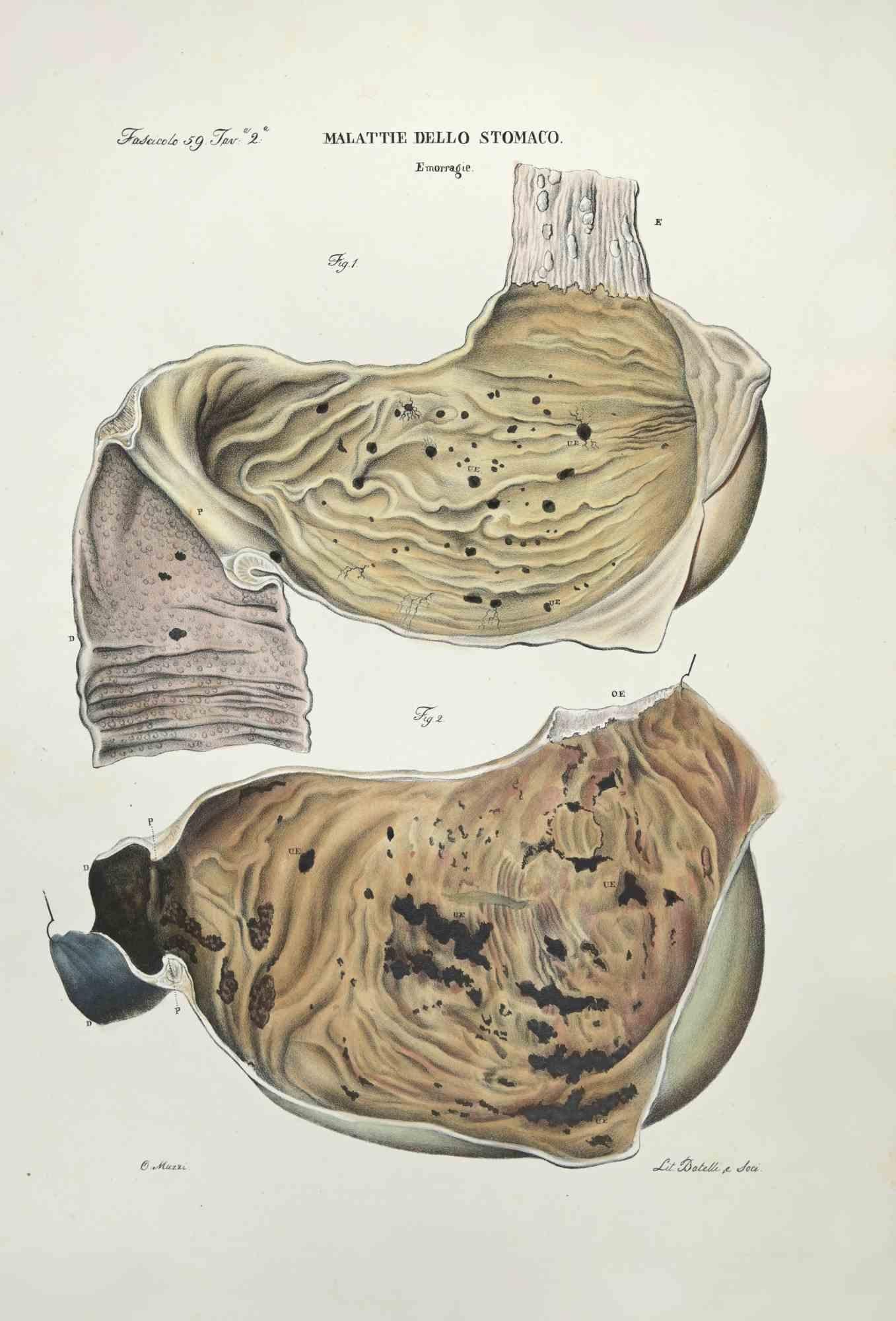 Stomach Diseases is a lithograph hand colored by Ottavio Muzzi for the edition of Antoine Chazal,Human Anatomy, Printers Batelli and Ridolfi, realized in 1843.

Signed on plate on the lower left margin.

The artwork belongs to the "Atlante Generale