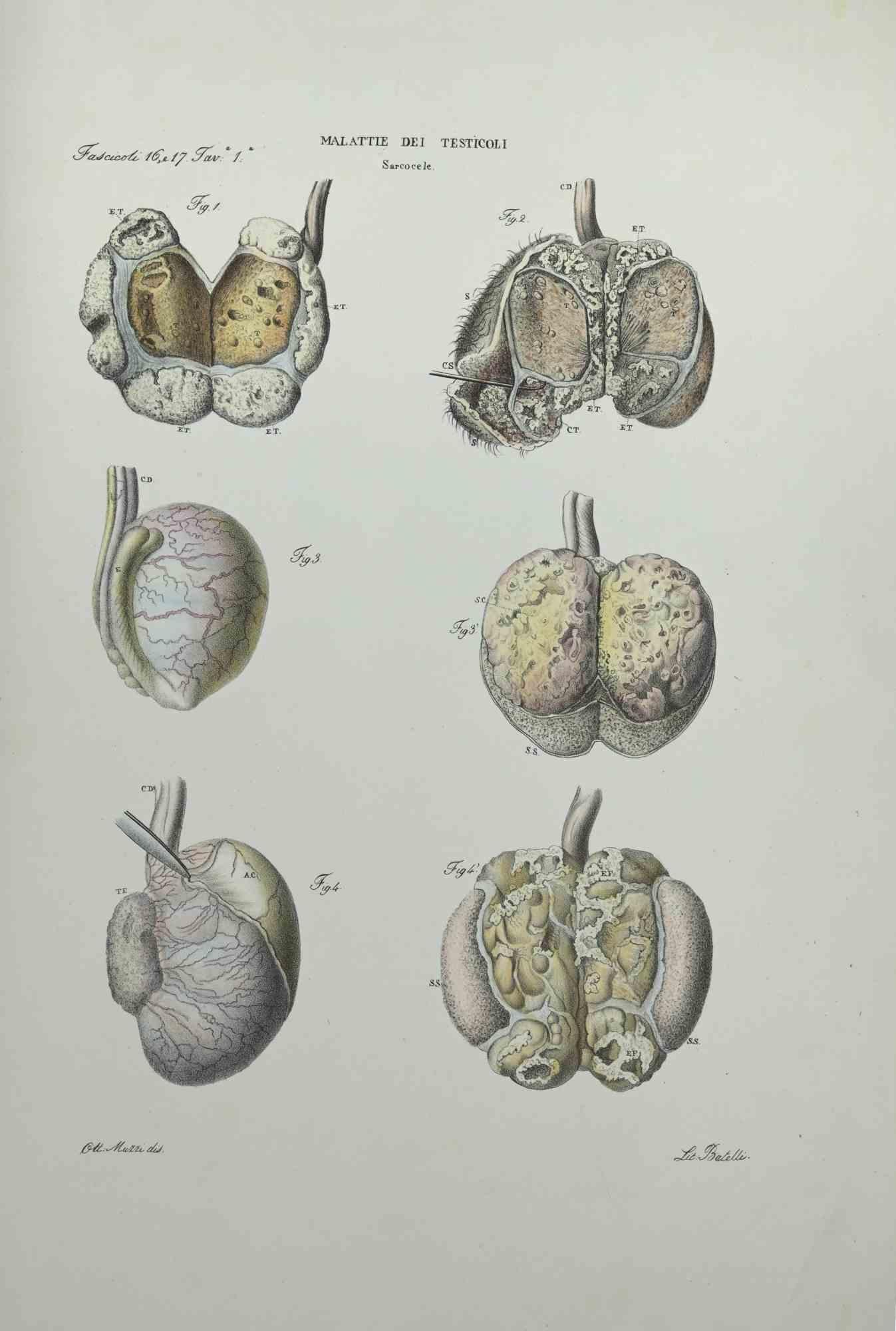 Testicles Diseases - Lithograph By Ottavio Muzzi - 1843