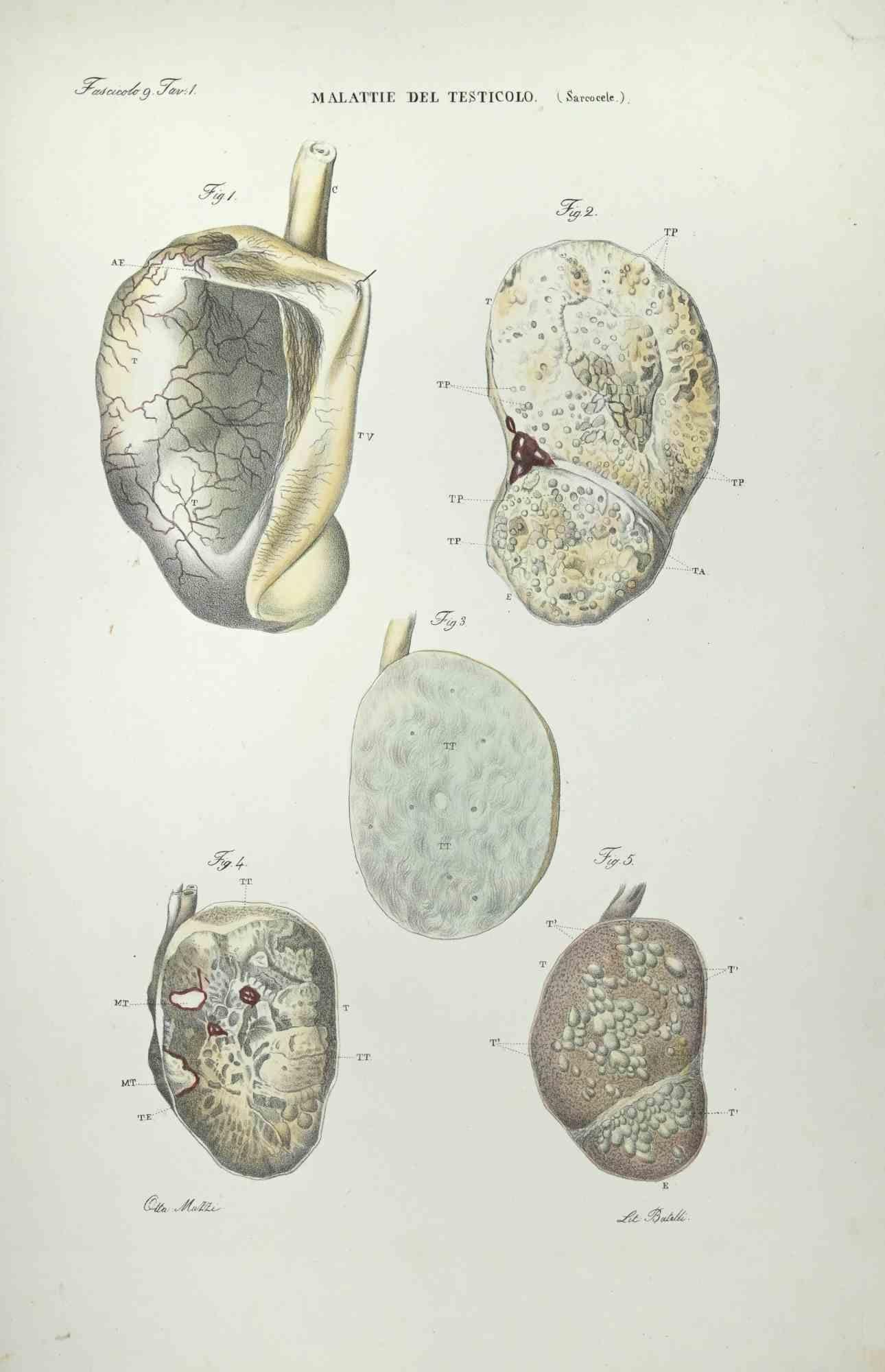 Testicular Diseases is a lithograph hand colored by Ottavio Muzzi for the edition of Antoine Chazal, Human Anatomy, Printers Batelli and Ridolfi, 1843.

The work belongs to the Atlante generale della anatomia patologica del corpo umano by Jean