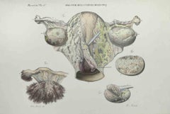 Uterus Disease - Lithograph By Ottavio Muzzi - 1843