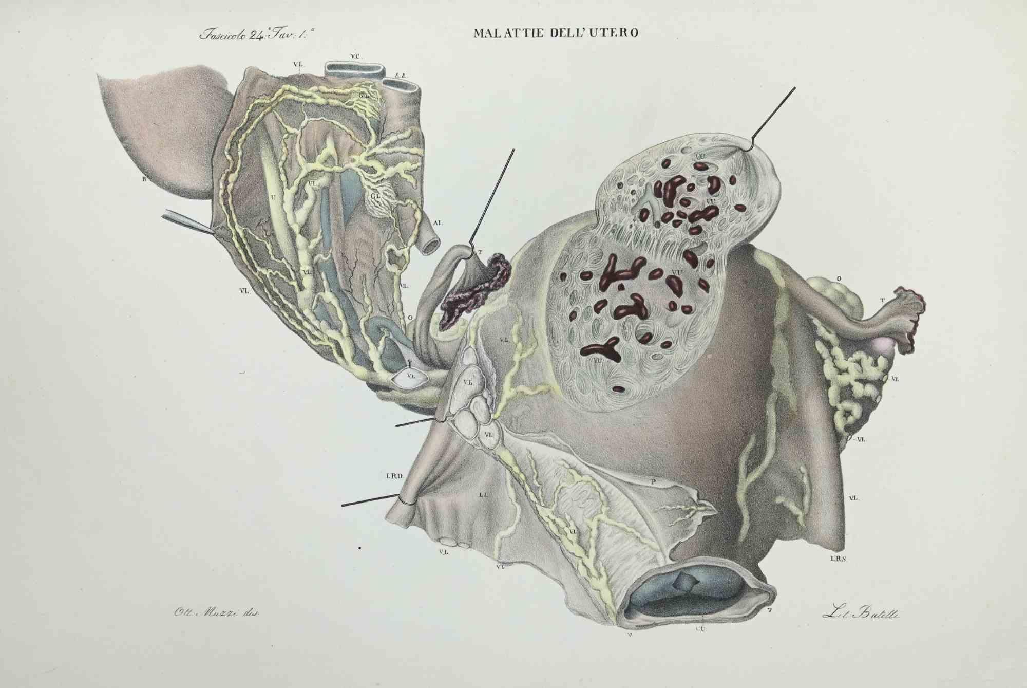 Uterus Diseases is a lithograph hand colored by Ottavio Muzzi for the edition of Antoine Chazal,Human Anatomy, Printers Batelli and Ridolfi, realized in 1843.
Signed on plate on the lower left margin. 

The artwork belongs to the "Atlante Generale