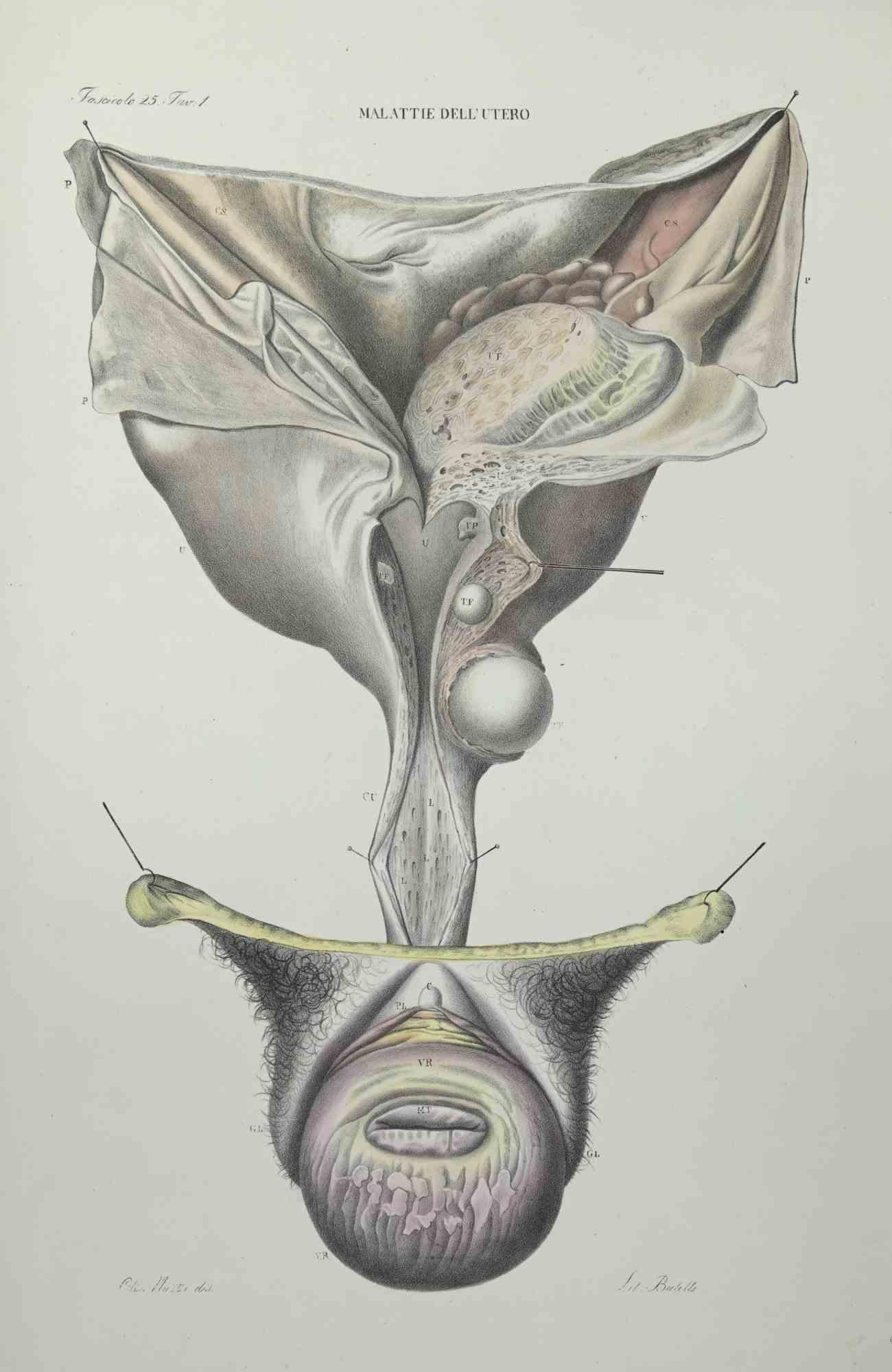Uterus Diseases is a lithograph hand colored by Ottavio Muzzi for the edition of Antoine Chazal,Human Anatomy, Printers Batelli and Ridolfi, realized in 1843.
Signed on plate on the lower left margin. 

The artwork belongs to the "Atlante Generale