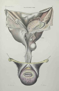 Uterus Diseases - Lithograph By Ottavio Muzzi - 1843