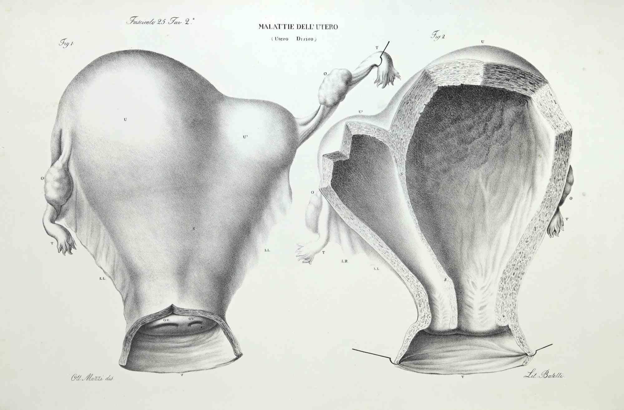 Les maladies du utérus - Lithographie d'Ottavio Muzzi - 1843