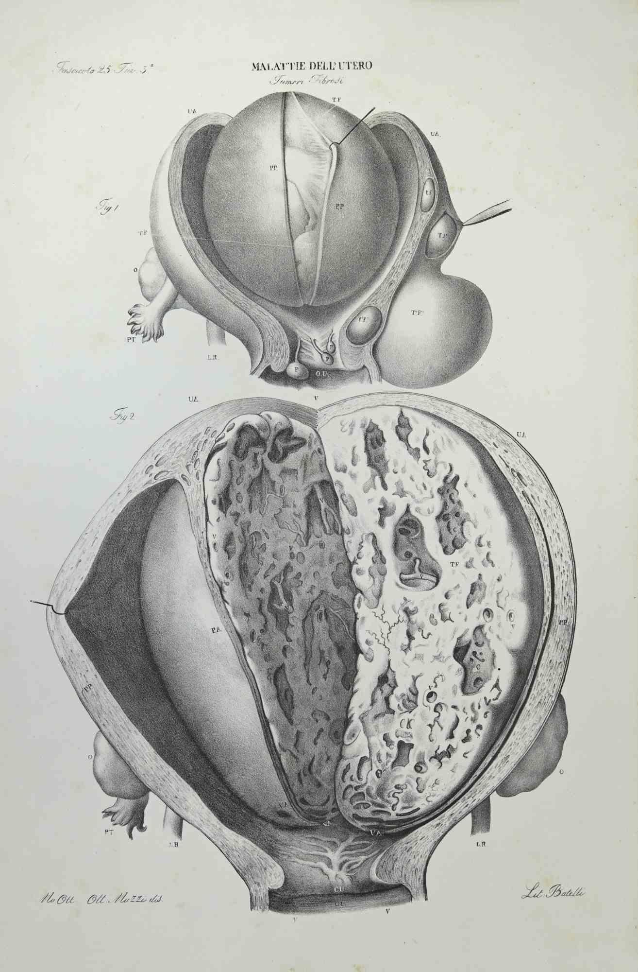 Uterus Diseases is a lithograph hand colored by Ottavio Muzzi for the edition of Antoine Chazal,Human Anatomy, Printers Batelli and Ridolfi, realized in 1843.
Signed on plate on the lower left margin. 

The artwork belongs to the "Atlante Generale