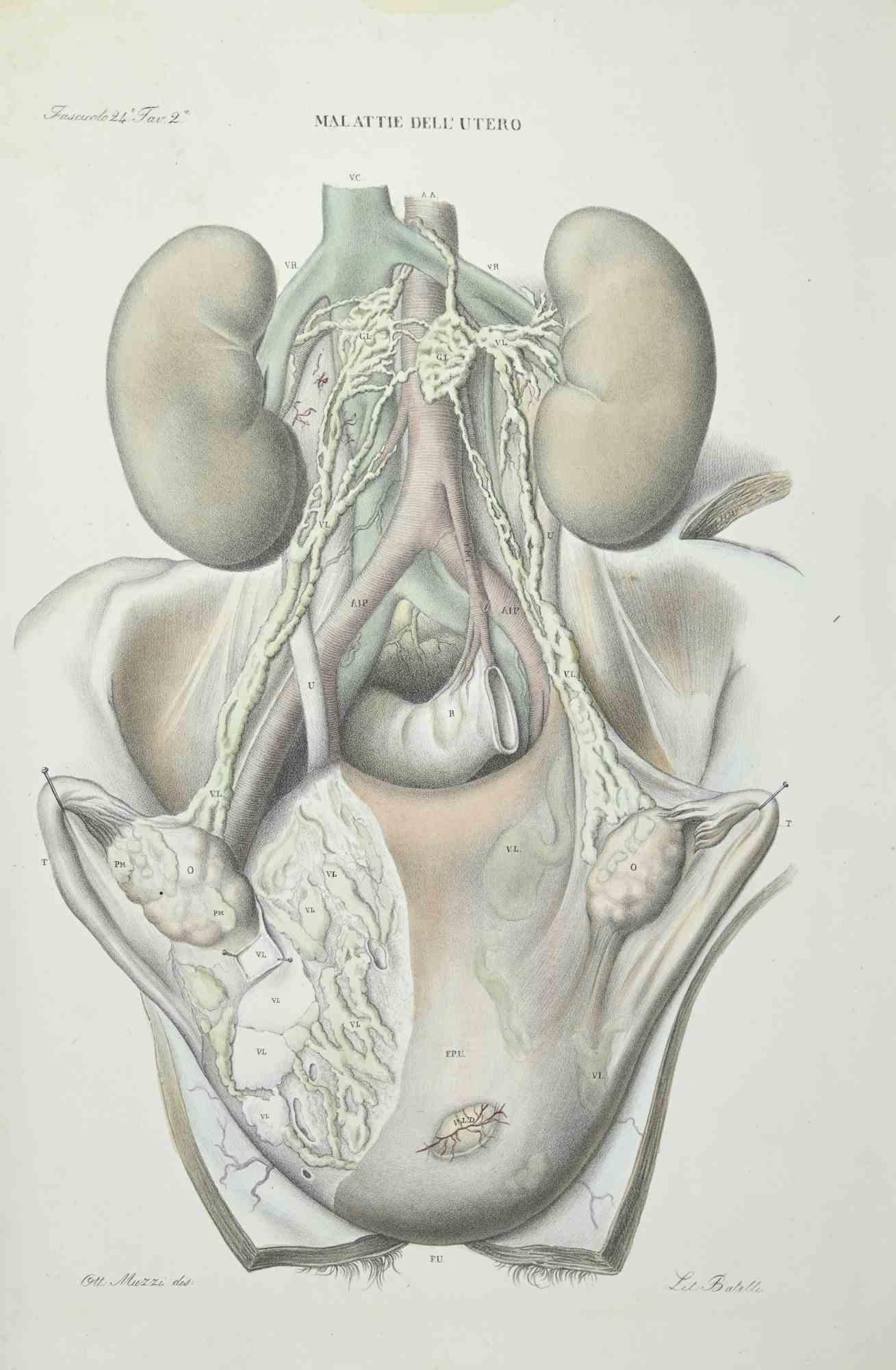 Uterus Diseases is a lithograph hand colored by Ottavio Muzzi for the edition of Antoine Chazal,Human Anatomy, Printers Batelli and Ridolfi, realized in 1843.
Signed on plate on the lower left margin. 

The artwork belongs to the "Atlante Generale