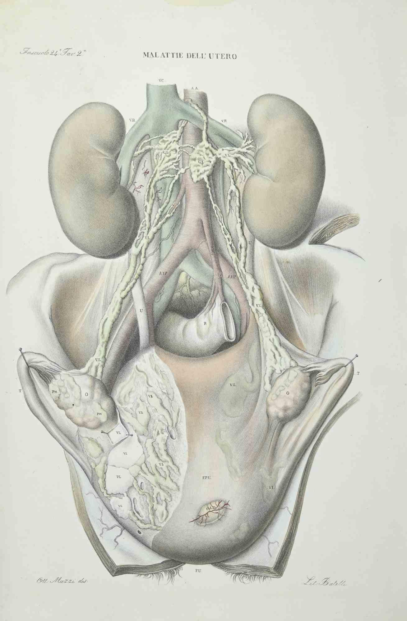 Uterus Diseases - Lithograph By Ottavio Muzzi - 1843