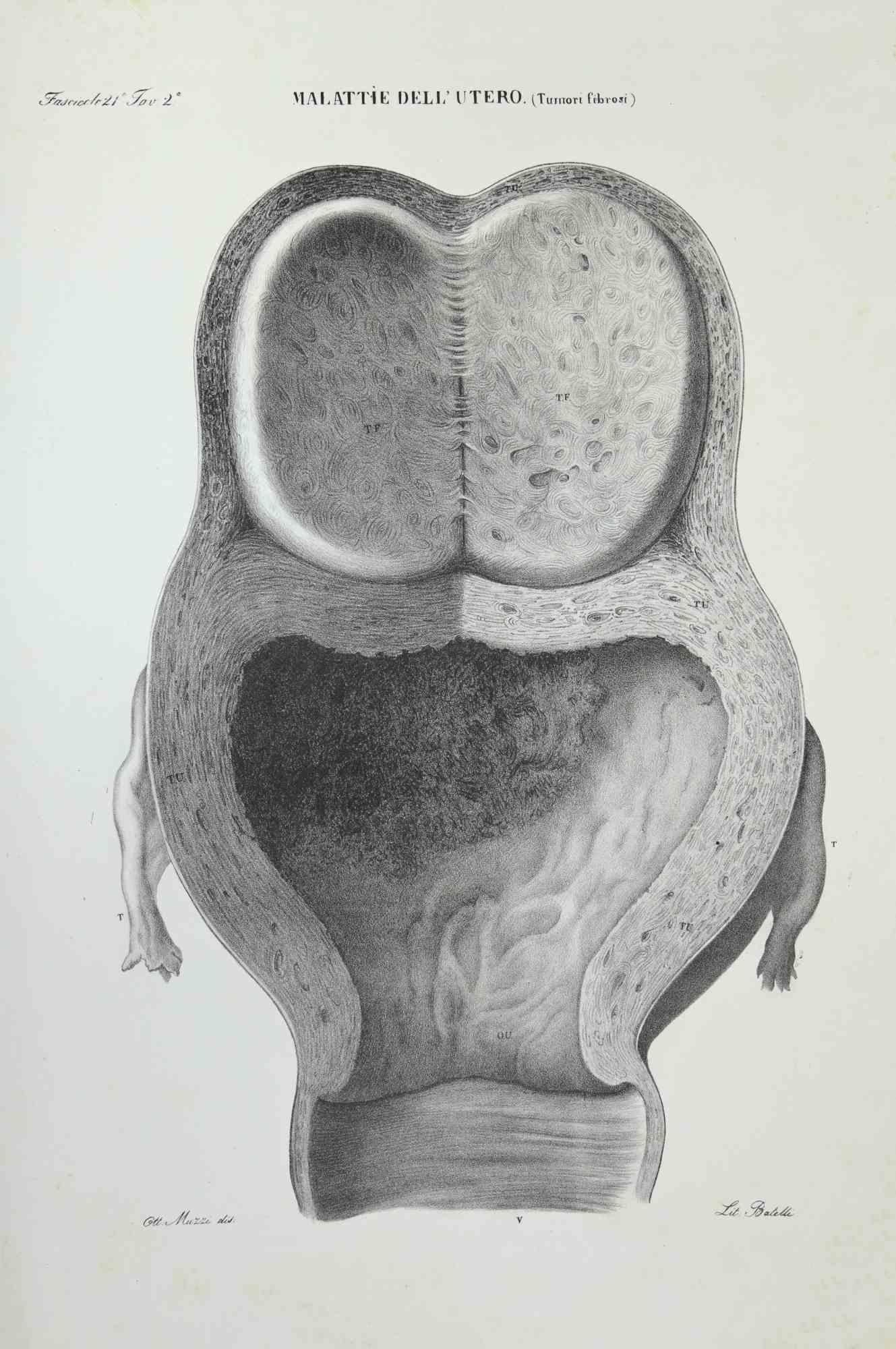 Maladies de l'utérus est une lithographie coloriée à la main par Ottavio Muzzi pour l'édition d'Antoine Chazal, Anatomie humaine, Imprimeurs Batelli et Ridolfi, réalisée en 1843.

Signé sur la plaque dans le coin gauche.

L'œuvre appartient à