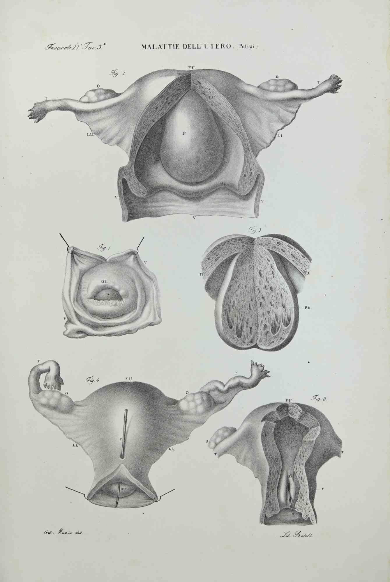 Uterus Diseases is a lithograph hand colored by Ottavio Muzzi for the edition of Antoine Chazal, Human Anatomy, Printers Batelli and Ridolfi, realized in 1843.

Signed on plate on the left corner.

The artwork belongs to the "Atlante Generale della