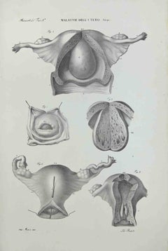 Uterus Diseases - Lithograph By Ottavio Muzzi - 1843