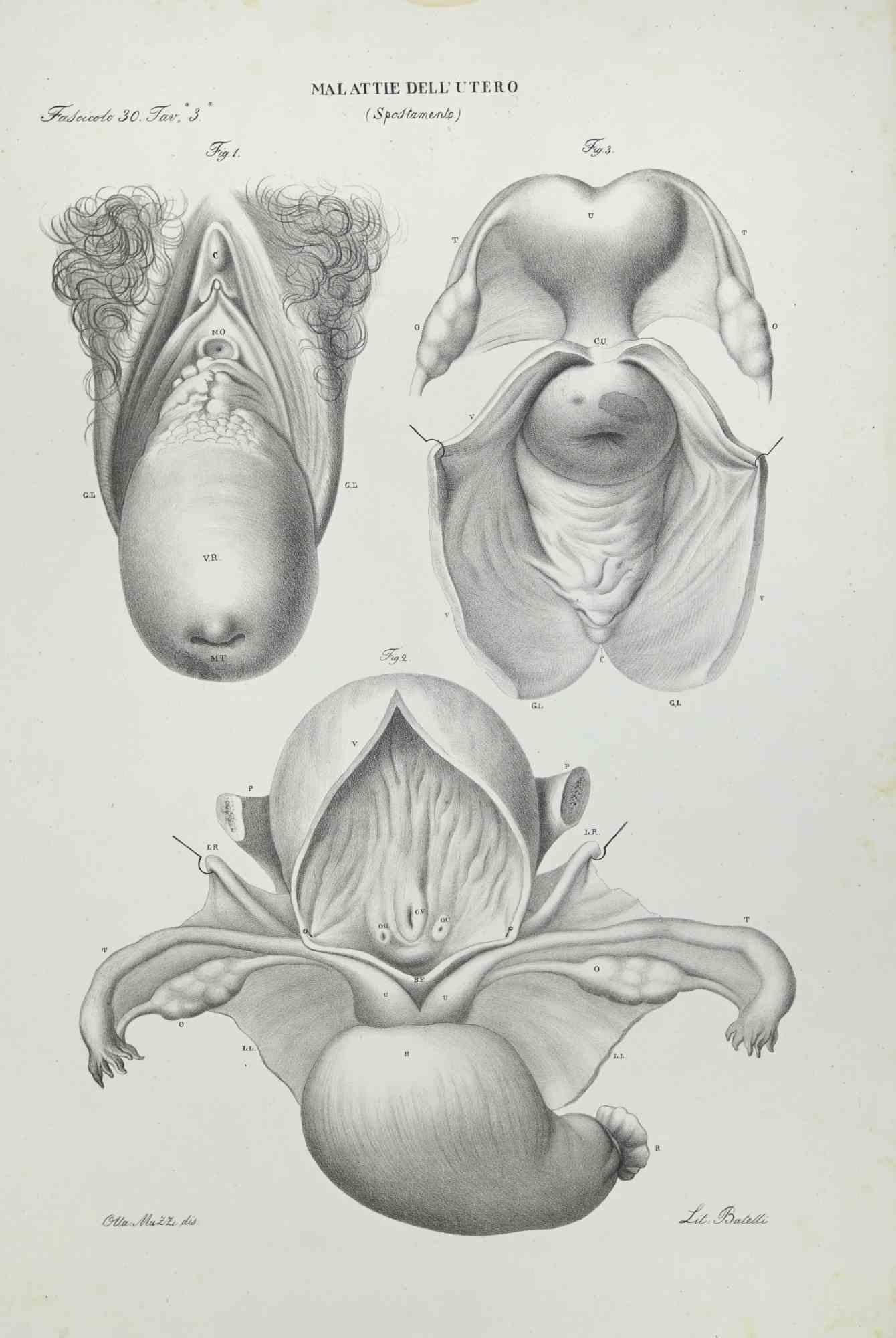 Uterus Diseases is a lithograph hand colored by Ottavio Muzzi for the edition of Antoine Chazal,Human Anatomy, Printers Batelli and Ridolfi, realized in 1843.
Signed on plate on the lower left margin. 

The artwork belongs to the "Atlante Generale