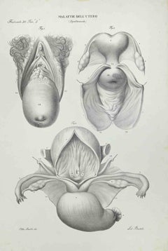 Malattie dell'utero - Litografia di Ottavio Muzzi - 1843