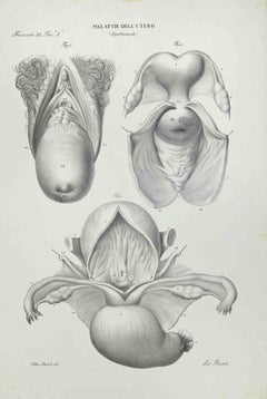 Uterus Diseases - Lithograph By Ottavio Muzzi - 1843