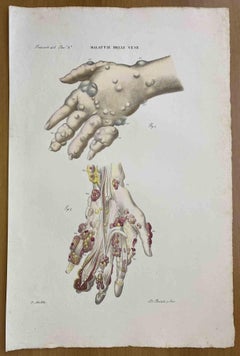 Vein Diseases - Lithograph By Ottavio Muzzi - 1843