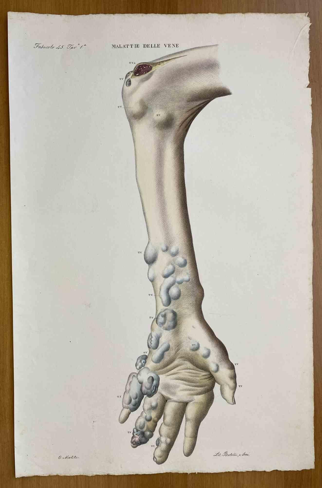  Vein Diseases is a lithograph hand colored by Ottavio Muzzi for the edition of Antoine Chazal, Human Anatomy, Printers Batelli and Ridolfi, 1843.

The work belongs to the Atlante generale della anatomia patologica del corpo umano by Jean