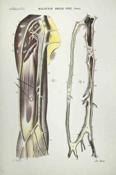 Antique Vein Diseases - Lithograph By Ottavio Muzzi - 1843