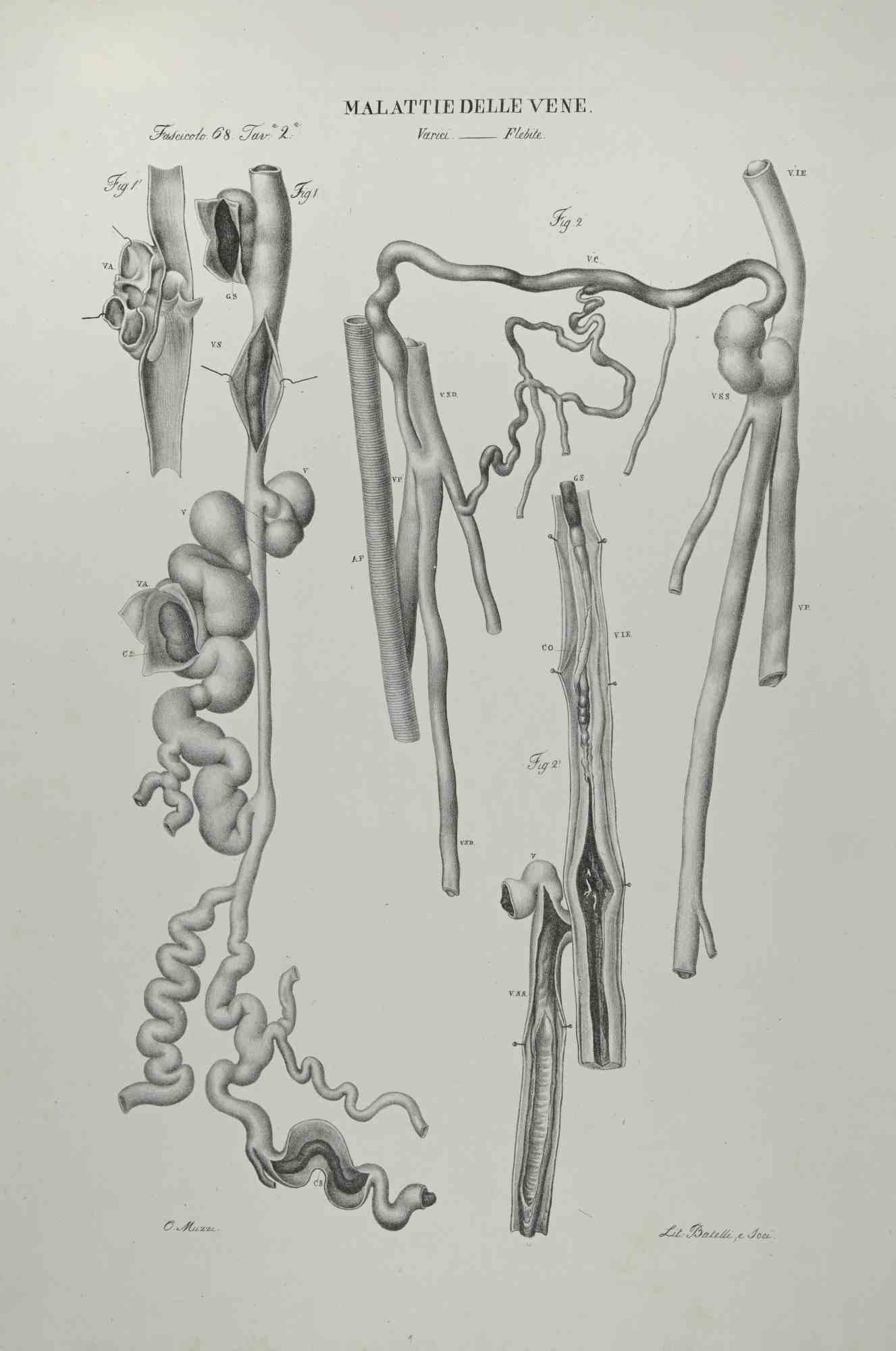 Vein Diseases is a lithograph hand colored by Ottavio Muzzi for the edition of Antoine Chazal,Human Anatomy, Printers Batelli and Ridolfi, realized in 1843.

Signed on plate on the lower left margin.

The artwork belongs to the "Atlante Generale