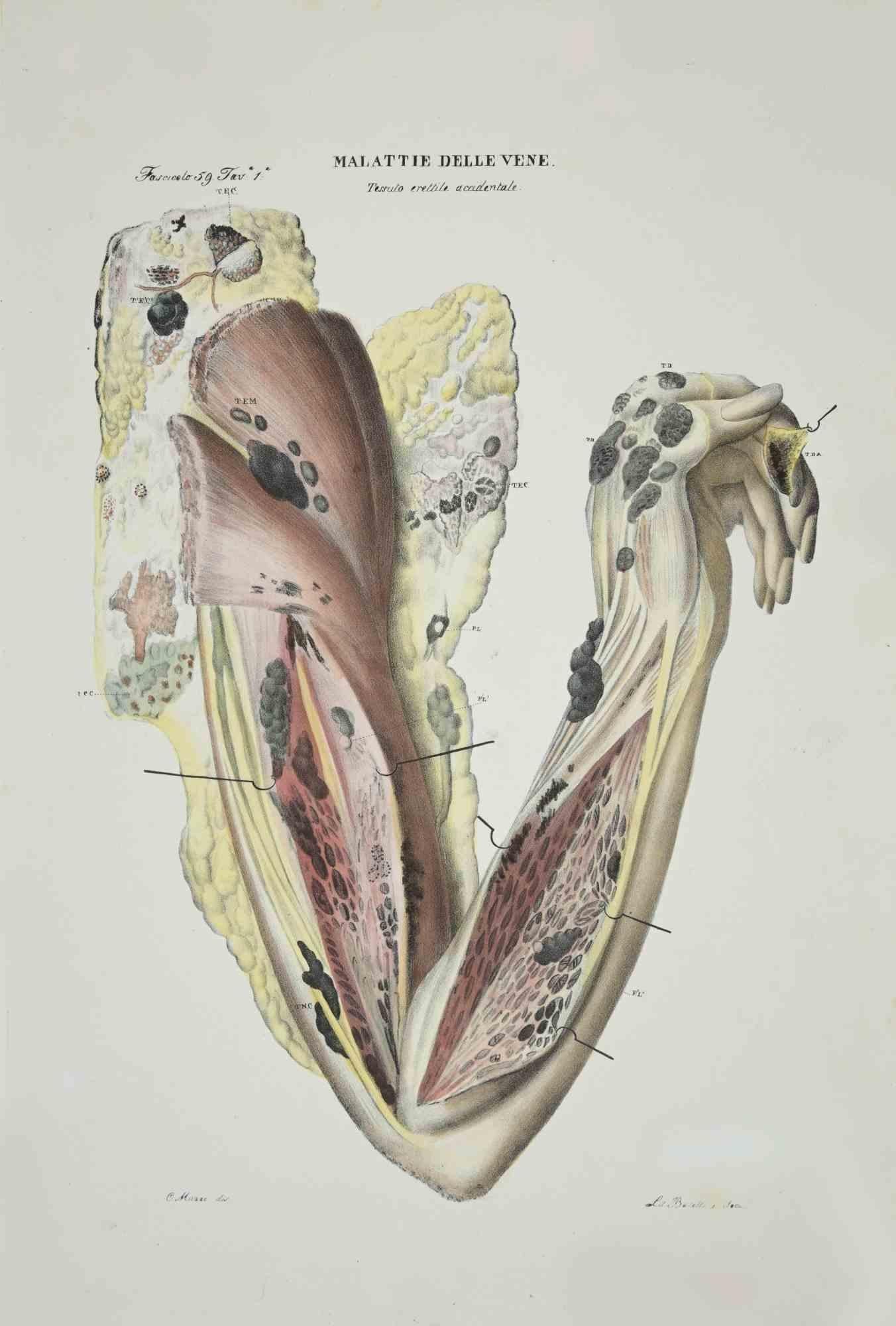 Maladies des veines est une lithographie coloriée à la main par Ottavio Muzzi pour l'édition d'Antoine Chazal, Anatomie humaine, Imprimeurs Batelli et Ridolfi, réalisée en 1843.

Signé sur la plaque dans la marge inférieure gauche.

L'œuvre