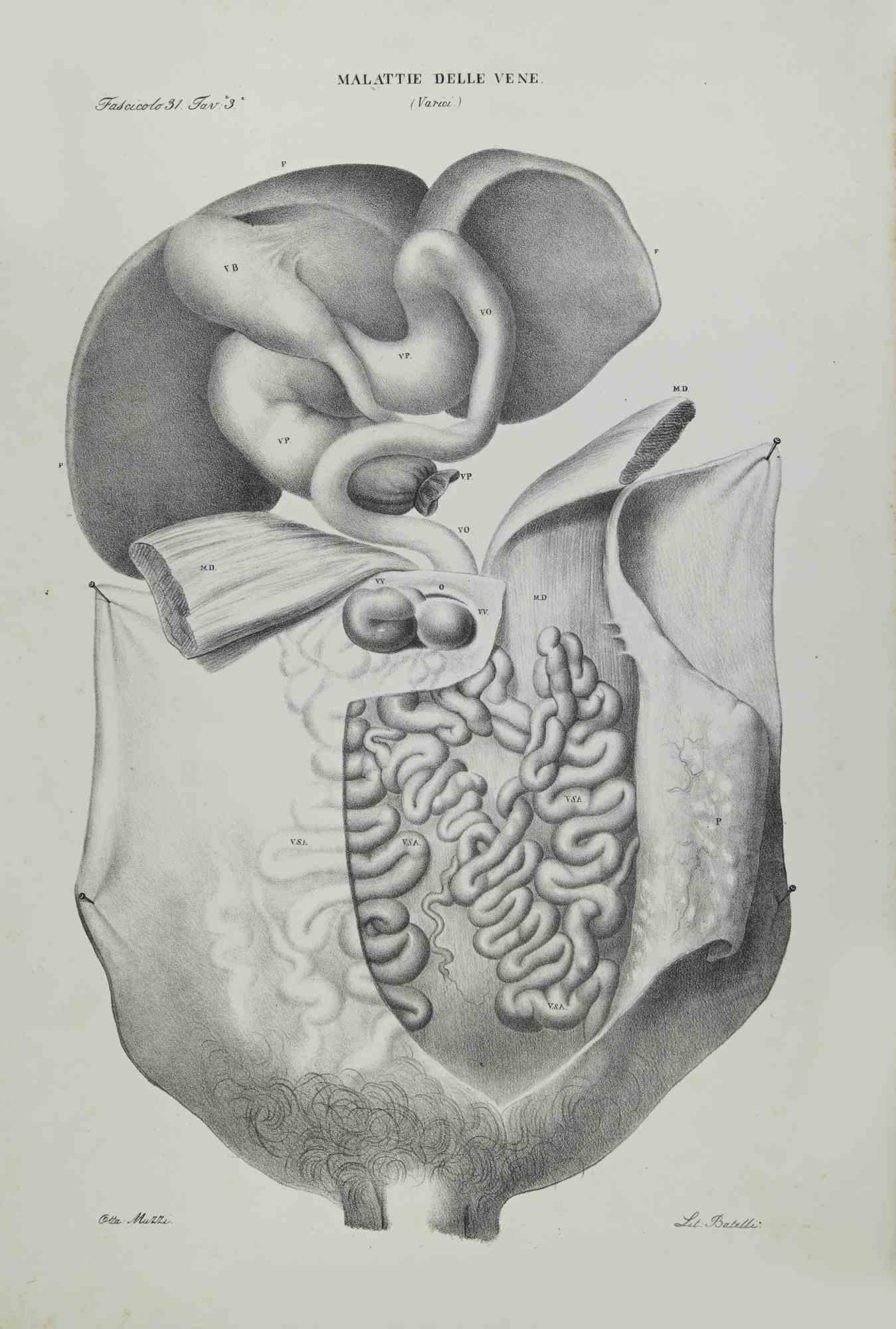Venenkrankheiten ist eine handkolorierte Lithographie von Ottavio Muzzi für die Ausgabe von Antoine Chazal, Menschliche Anatomie, Druckerei Batelli und Ridolfi, aus dem Jahr 1843.
Signiert auf der Platte am unteren linken Rand. 

Das Kunstwerk