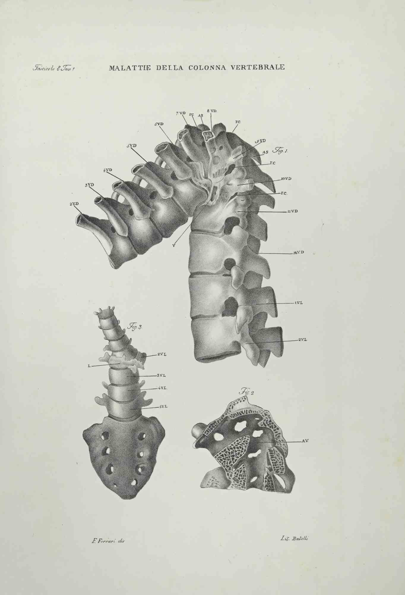 Vertebral Column Diseases - Lithograph By Ottavio Muzzi - 1843