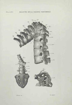 Antique Vertebral Column Diseases - Lithograph By Ottavio Muzzi - 1843