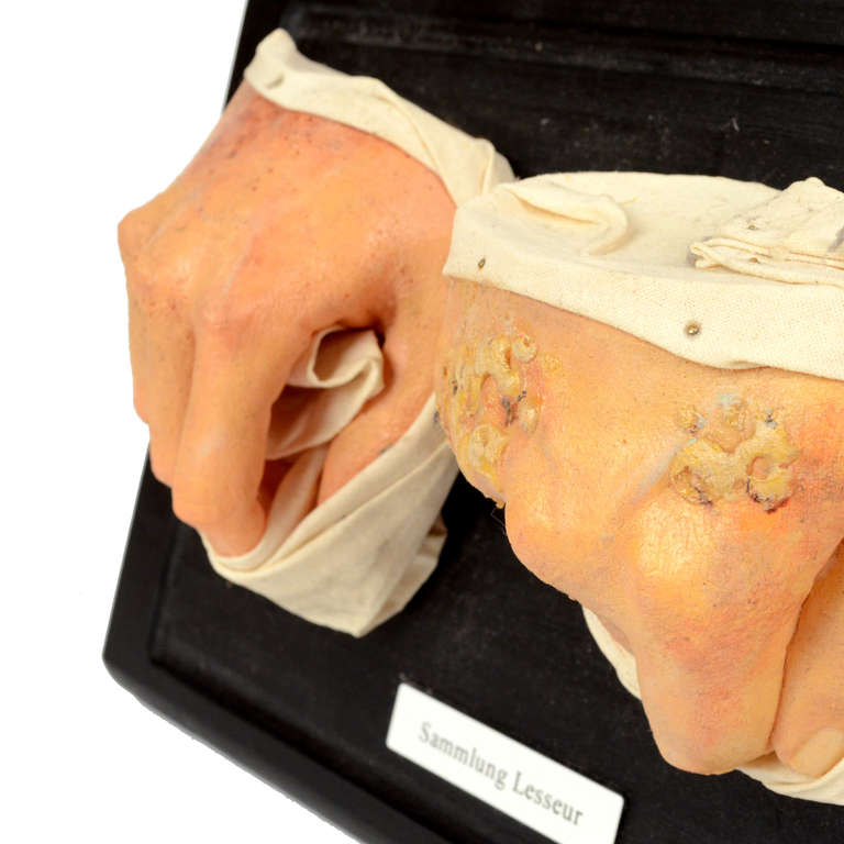 Pathological Wax Model Depicting Hans Dermatitis, 1950s In Distressed Condition In Milan, IT