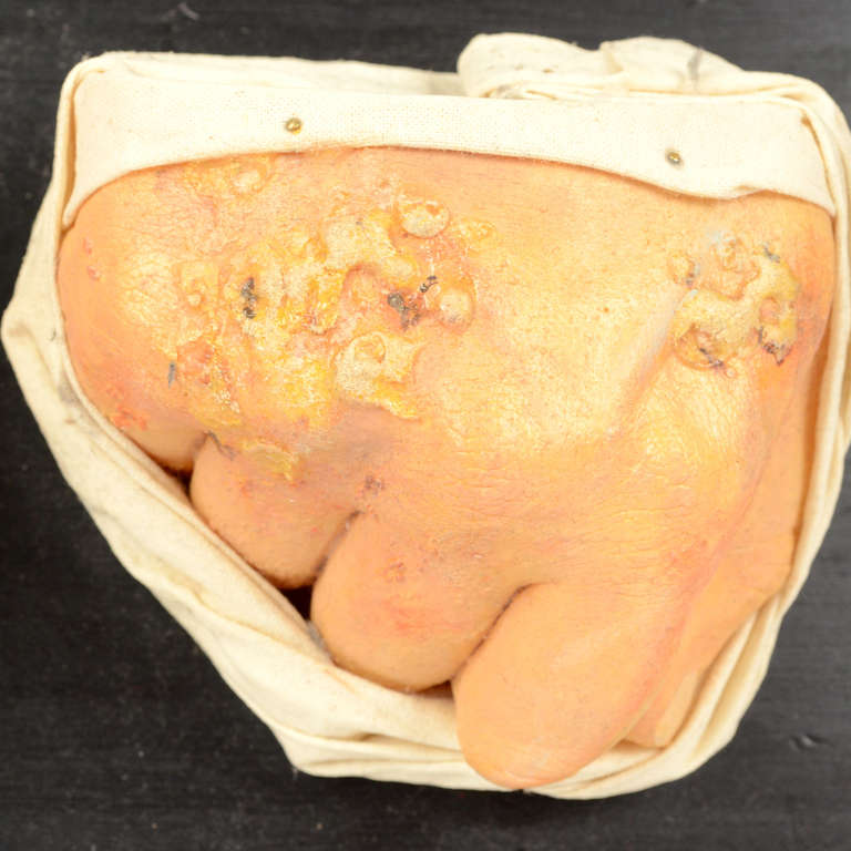 Wood Pathological Wax Model Depicting Hans Dermatitis, 1950s