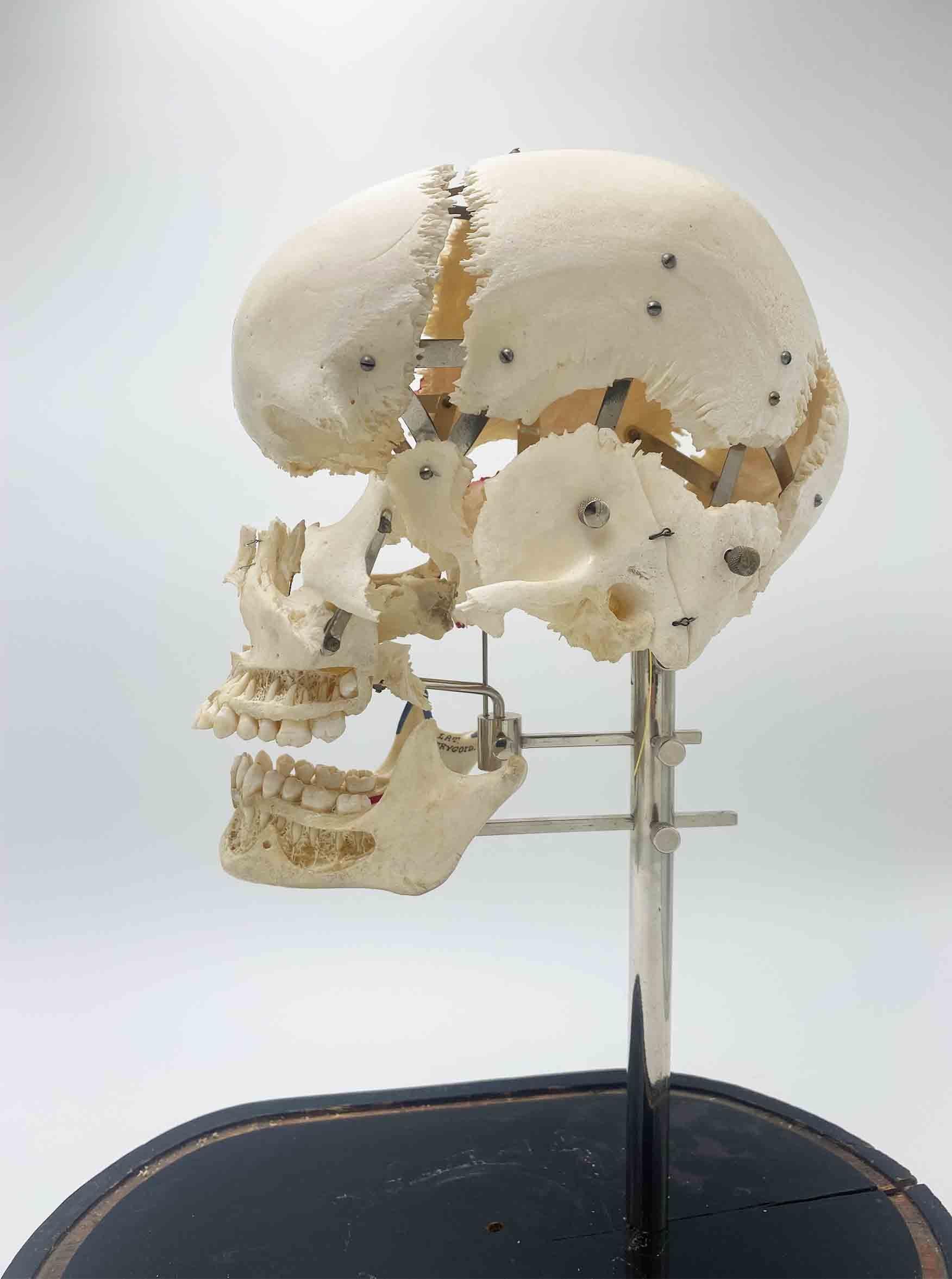 French Seldom Seen Authentic Exploding Skull, Medical, After Claude Beauchêne For Sale