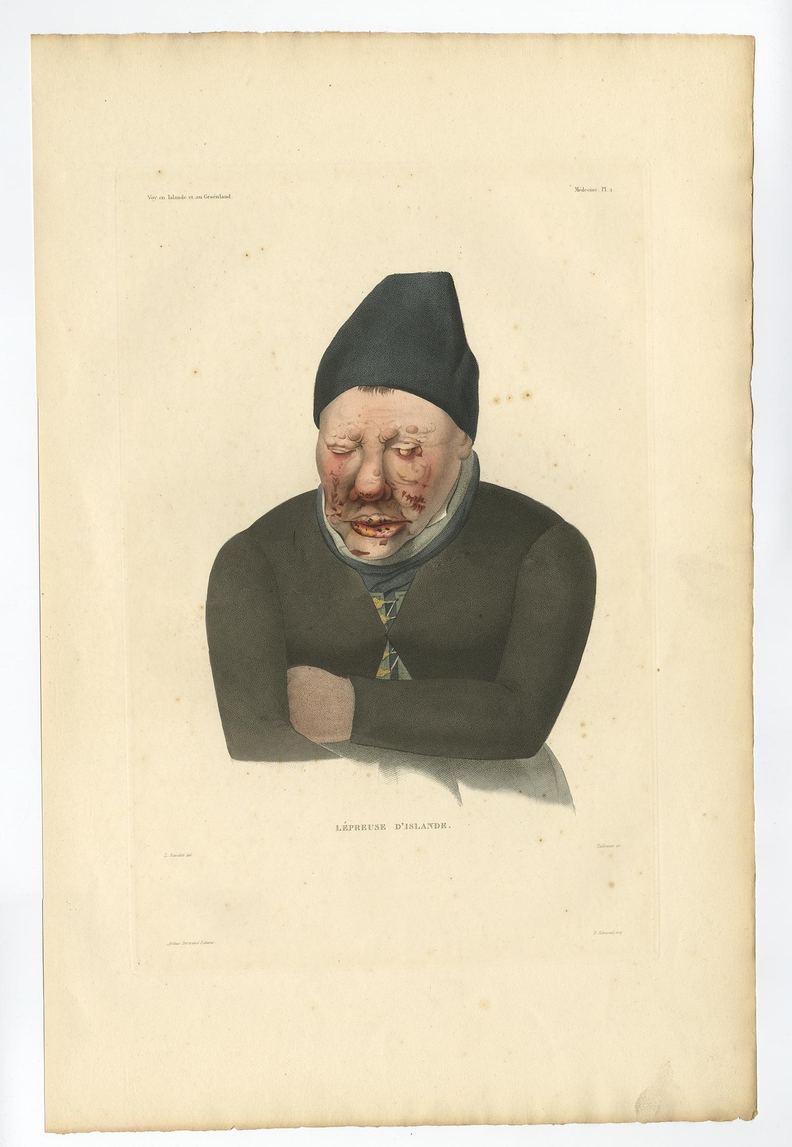 Set di tre stampe antiche di lebbrosi dall'Islanda - Gaimard Voyage, 1842 

Le stampe sono vendute senza cornice o pannello per l'opacizzazione. 

Questo raro set di tre litografie colorate a mano, ciascuna intitolata 