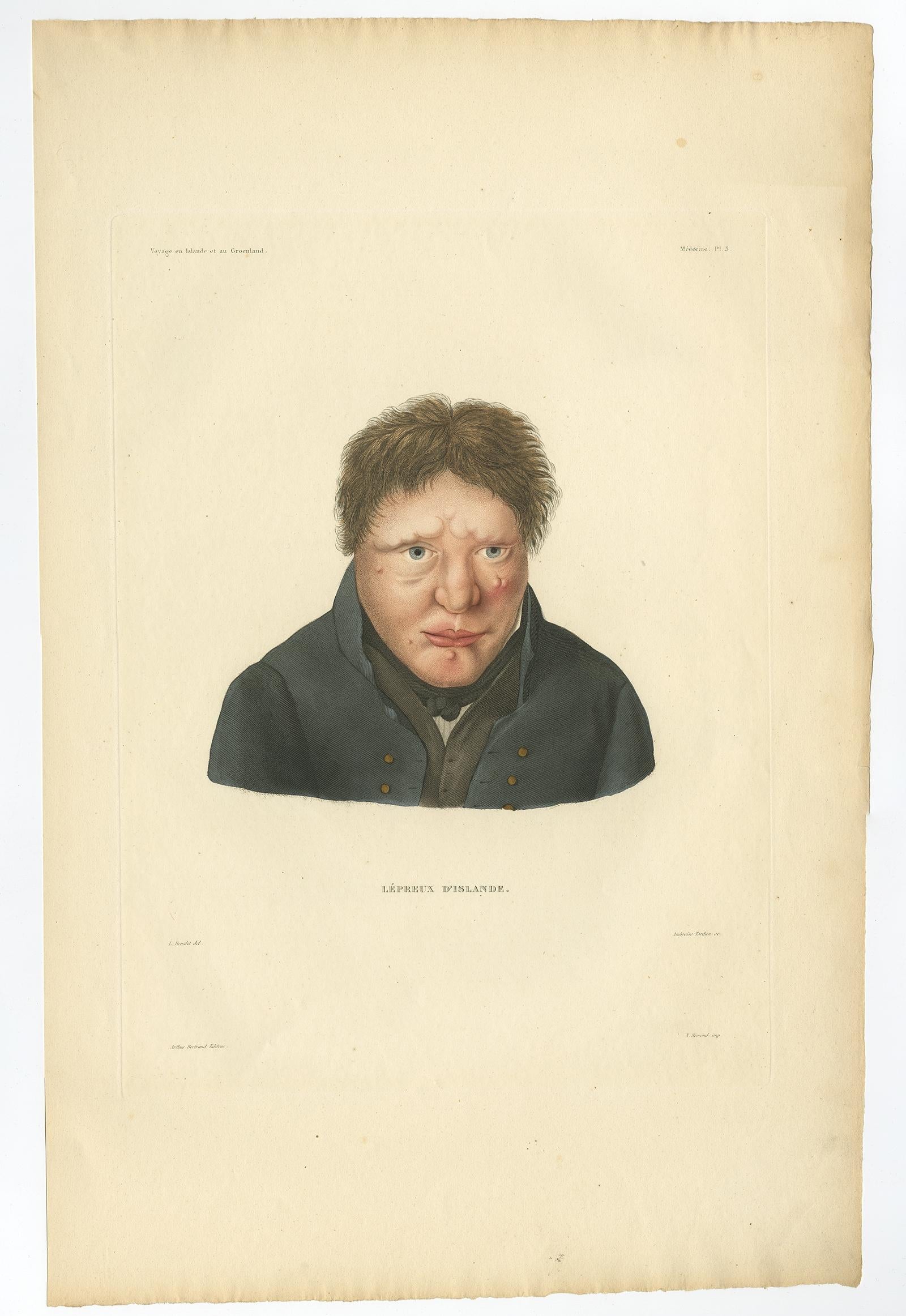 Francese Set di tre litografie antiche di lebbrosi dall'Islanda - Gaimard Voyage, 1842 in vendita
