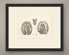 The Lateral Ventricles Opened, Antique Hirschfeld Anatomy Print, 1866