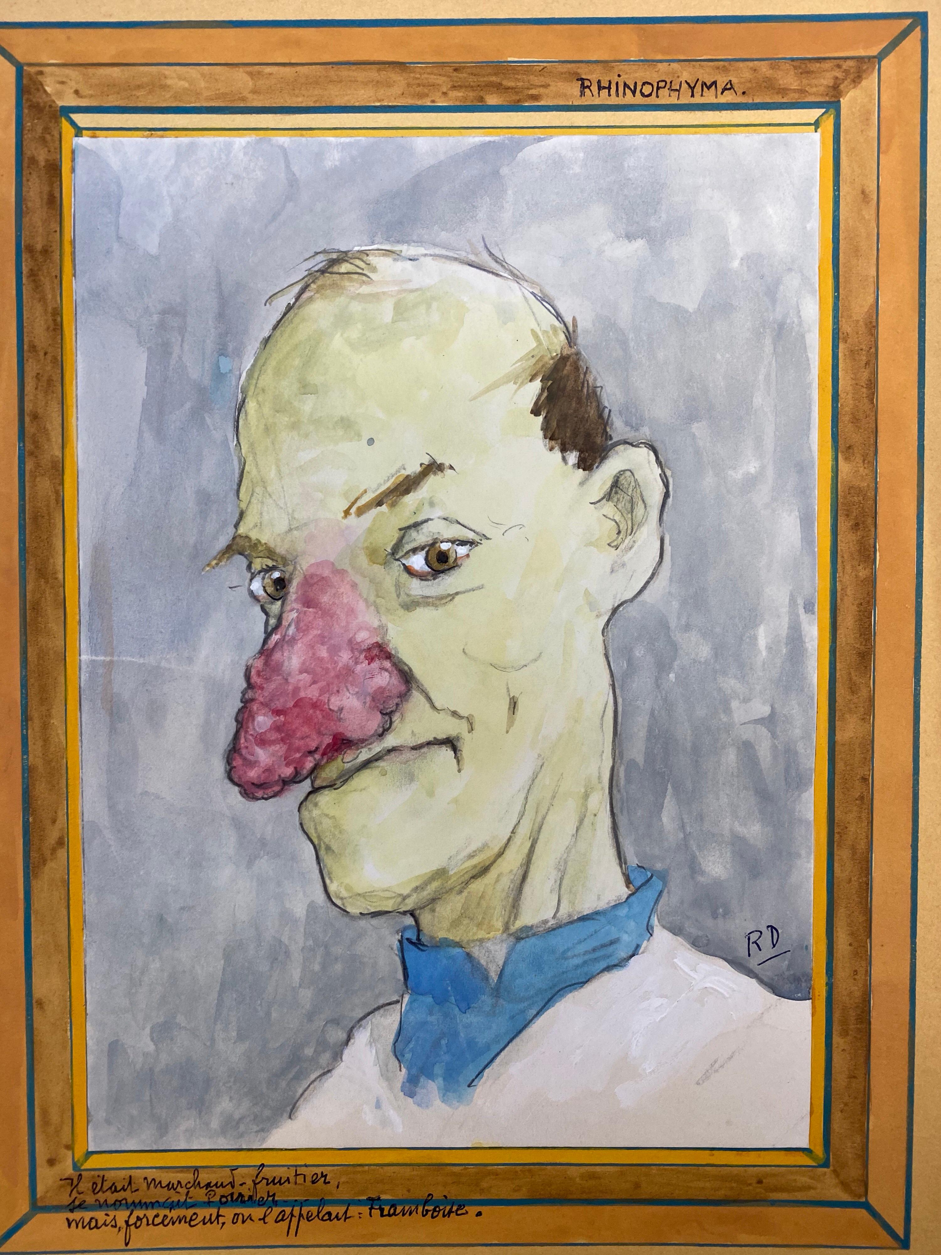 Unknown Figurative Painting - 1960's French Portrait Man Very Red Nose Caricature