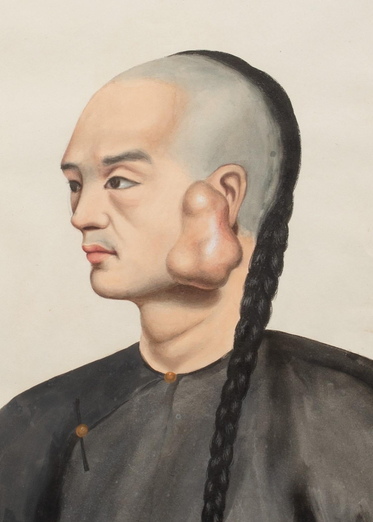Medical Portrait Of A Chinese Cancer Patient, 19th Century  - Painting by Unknown