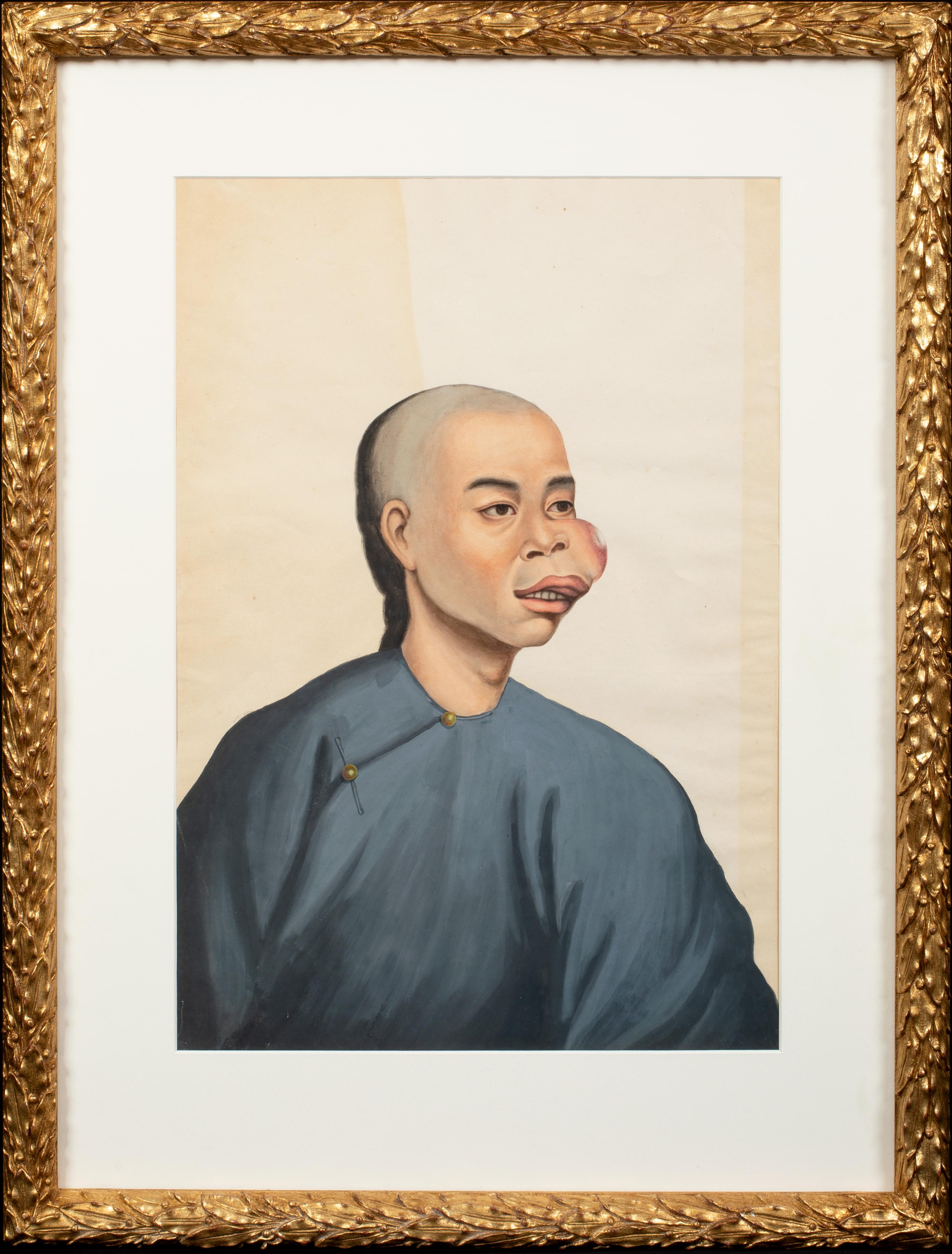 Unknown Portrait Painting - Medical Portrait Of A Chinese Cancer Patient, 19th Century 