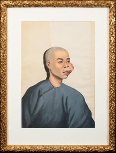 Medical Portrait Of A Chinese Cancer Patient, 19th Century 