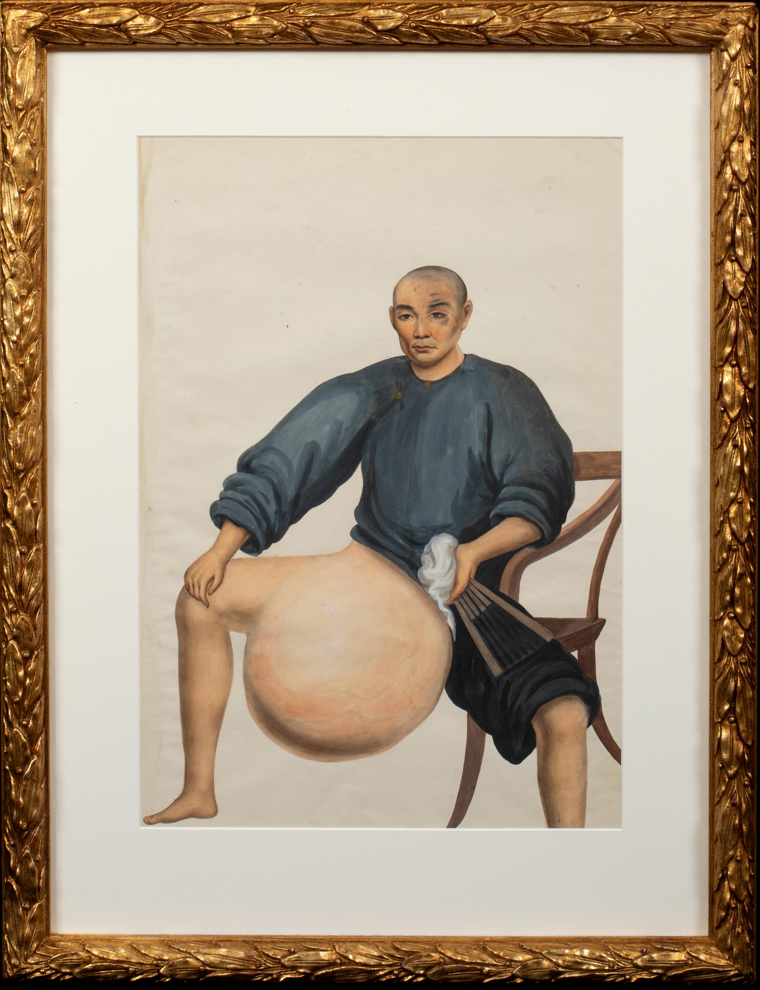 Unknown Portrait Painting - Medical Portrait Of A Chinese Cancer Patient, 19th Century 