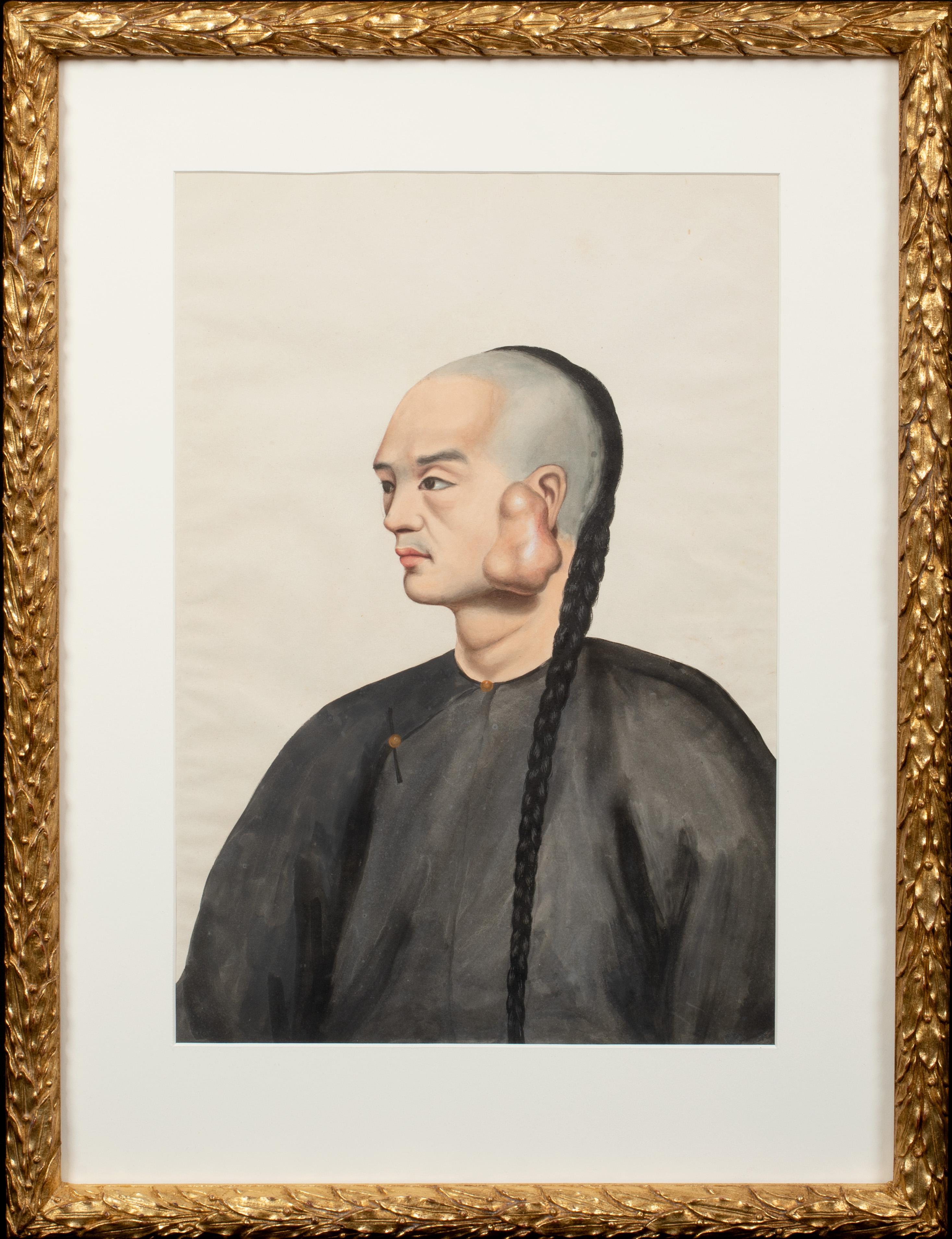 Unknown Portrait Painting - Medical Portrait Of A Chinese Cancer Patient, 19th Century 